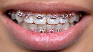 Invisalign in Nashua NH, Clear Braces