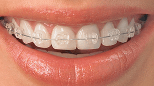 Invisalign in Nashua NH, Clear Braces